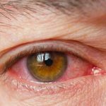 what-is-dry-eye-symptoms-treatment-causes-722×406
